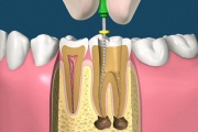 Endodonzia